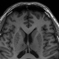 MRI image of a patient with enlarged perivascular spaces