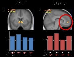 Two bar graphs and an MRI scan of a brain